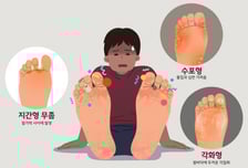 워터파크 갔다가…"어떡해, 무좀 옮았나봐"[한 장으로 보는 건강]