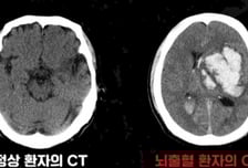 "망치로 내려찍는 듯한 두통" 고혈압 환자의 '이 증상' 골든타임도 없다