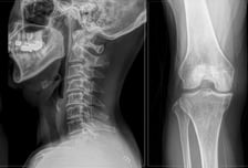 허리 아파 병원 가니 "무릎에도 병이"…10명 중 6명 동시에 앓는다