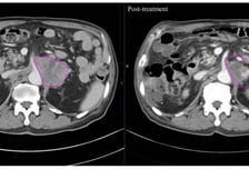 "암세포만 골라 죽였다"…방사선보다 더 효과 보인 이 치료법