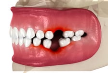 치아 빠졌다고 그냥 두지 마세요…"8개 없으면 사망위험 10%↑"