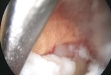 현미경보다 절반 덜 째는 '양방향 내시경' 허리디스크 치료 효과 더 좋아