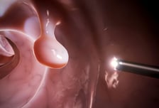 "정확도 80% 가까워" 희귀한 대장 용종까지 샅샅이 찾는 AI 나왔다