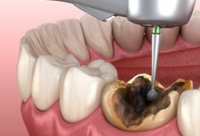 치아가 건강해야 몸도 건강하다…'이 빠진' 중년, 암 발병률 '쑥'