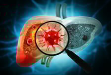 간암 76% 없앨 수 있다…백신·치료제 다 있는 '이 병' 관리 시급
