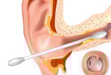 청력 손실·악성 외이도염…습관적으로 귀 파다 뇌염까지? [한 장으로 보는 건강]