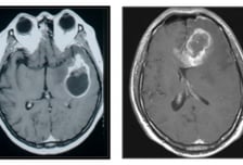 메스껍고 토악질, 가벼이 넘겼는데…뇌종양이라고요?