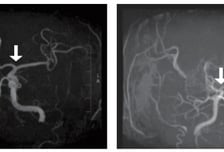 서울대병원 "소아 뇌졸중 부르는 모야모야병, 피 뽑아 조기 진단"