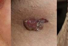 눈에 화상까지…사방에서 몰아치는 자외선, 양산으론 부족해