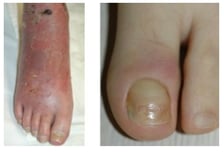 바닷물 잠깐 들어갔을 뿐인데 몸살 기운에 다리가 '퉁퉁'…방치했다간