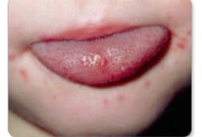 수영장 다녀오더니 열 펄펄…"해열제 소용없다" 아이들 위협하는 이 병