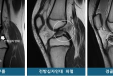 똑같이 넘어졌는데 '십자인대 파열' vs '무릎뼈 골절'…이유 밝혀냈다