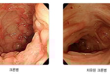 한국서 2030대 환자 확 늘었다…"배 아프다가 멀쩡" 완치 어려운 이 병