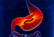 "다 늙어서 헬리코박터 없애면 무슨 소용" 이랬던 노인, 치료 결과 보니