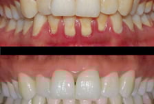 감기보다 많이 걸리는 입속 '국민질환'…고혈압·치매 위험까지