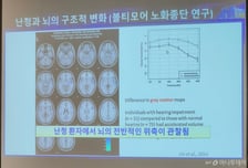 "보청기? 난 그 정도 아냐" 난청 노인 87% '방치'…치매도 부른다
