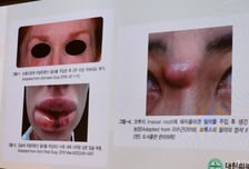 피부과 '전문의' 2950명 vs 피부 의료기관 3만곳…미용 부작용 7.7배