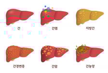 2030 '지방간' 증상 없어 방심했는데…"50세 되기 전 암 위험 20%↑"