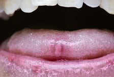 "구내염인 줄 알았는데"…혀 사진 찰칵, AI가 잡아낸 깜짝 진단