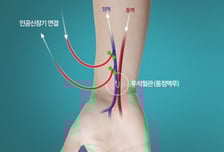 혈액투석하다 막힌 혈관, 피부 절개 않고도 바로 뚫는 '이 시술'