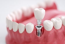 부쩍 빨라진 임플란트 시술, 4050 시술 전 필수 체크리스트는