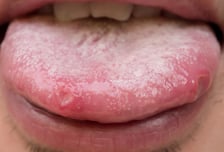 "무리했나" 입 속 궤양 뒀더니 시력 잃고 마비?…2040 노리는 '이 병'