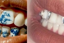 멀쩡한 치아에 "부자 되자" 타투…중국 MZ들 유행이라는데