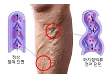 "또 졸고 있네, 또" 단순 피로인 줄 알았는데…뜻밖의 질환 숨어 있었다