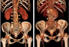 뱃속서 쿵쿵? 터지면 치명적…'조용한 시한폭탄' 70대 남성 노린다