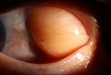 늙는 것도 서러운데…눈 흰자 위에 노란 혹이 '볼록', 어떤 병?
