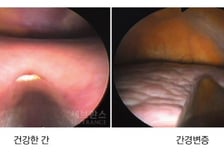 고환 작아진 남성, '거미 다리' 혈관까지 보인다면…'이 암' 위험신호?