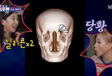 박소영, 코 가운데 실리콘 '우뚝'…탁재훈 "담배 아냐?" 경악