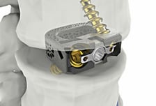 시지메드텍, 척추 임플란트 '유니스페이스' 美 FDA 승인