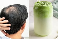 커피 대신 '말차' 마셨는데 머리 '숭숭'?…전문가 진단은