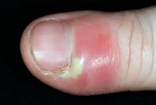 손톱 거스러미 뜯었더니 '퉁퉁'…"세균 침투 신호" 무시했다간[한 장으로 보는 건강]