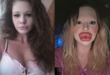 "입술 너무 커" 의사들이 혐오?…매달 '필러' 맞은 20대 여성, 사진 보니