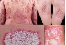 사람 몸에 '비늘'이…"서른 넘어 웬 아토피가?" 추울 때 심해지는 이 병