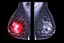 비만 아니고 너무 말라서?…40대 후반 한국 여성, 왜 '이 암' 많나 했더니