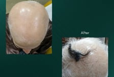 "머리카락이 쑥쑥, 흰머리가 검게"...BBC도 주목한 한국 바이오 회사