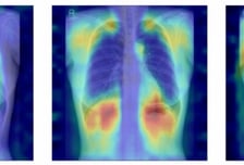 흉부 엑스레이만 찍어도 '골다공증' 알 수 있다…AI 개발한 서울대병원