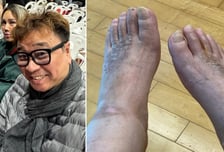 '하반신 마비 25년' 강원래 발 상태…"발톱 빠져도 통증 못 느껴"