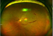 흐릿한 눈 앞, 나이 탓만 했다간...'조용한 실명' 다가온다