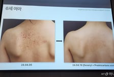 아토피피부염 치료 시작은 '보습'…WHO가 인정한 '황금레시피' 나왔다