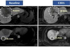 보로노이, 'VRN10' 초기 용량부터 항종양 확인…ADC 병용 기대감↑