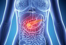 구멍 1개만 뚫는 '이 수술법', 췌장 머리 종양 없앤 후 통증·감염 ↓