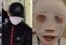 "예쁜 아내 떠날까봐" 끓는 물 테러한 남편...돌연 "실수" 말 바꿨다