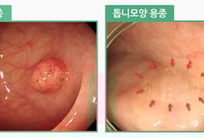 "나 대장 용종 뗐대" 암 불안감에 덜덜...의사는 "오히려 안심" 왜?