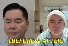 심형래, 얼굴 전체에 붕대 '칭칭'...수술 후 부은 모습, 무슨 일?