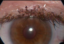 "속눈썹에 검은점 바글바글"...50대 남성, 성관계 후 '이것' 전염