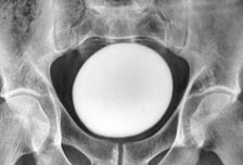 "뱃속에 타조알이?"…35세 남성 방광서 발견된 거대 결석 '충격'